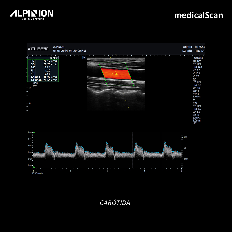 imagen clínica de la carótida con ALPINION X-CUBE 50